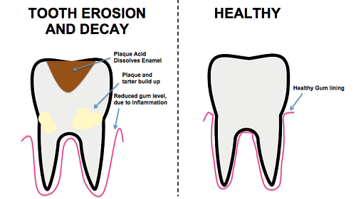 diagram showing initial tooth decay