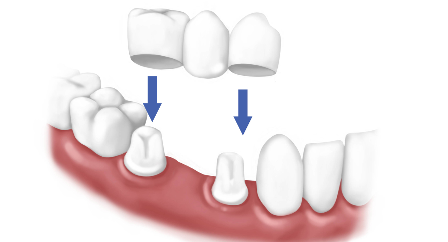 Caps and Crowns Mississauga Dentist Can Take Care of Your ...