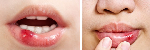 Cold sore blowjob Cold sore blowjob