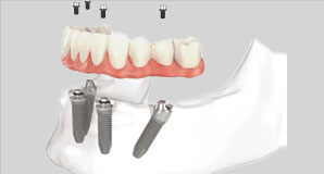 all-on-4-dental-implants-mississauga