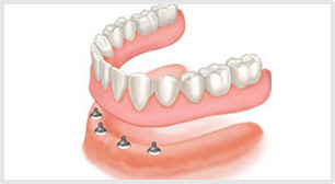 ball-retained-denture-implants