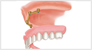 bar-retained-denture-implants