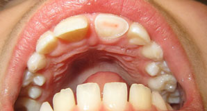 cracked-tooth-mississauga