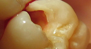 dental-fillings-mississauga