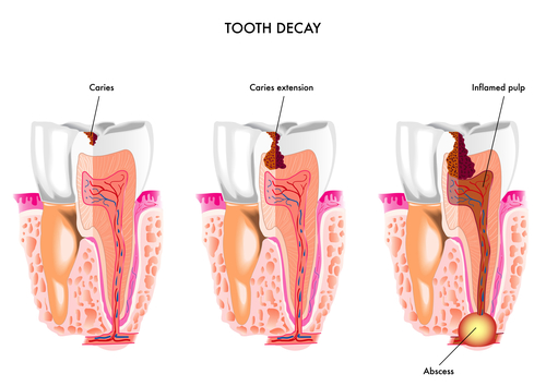 filling cavity archives city square dental cavity symptoms